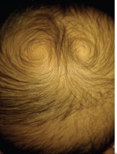 Chevelure à deux spires, l’une dextre, l’autre sénestre. Figure 2 in référence 2