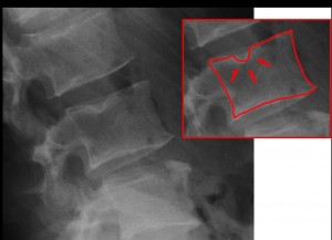 Radiographie de vertèbres lombaires affectées de nodules de Schmorl  (cliché Wikipedia)