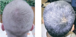 La spire dextre ou sénestre de la chevelure. Emprunté à Amar J.S. Klar, 2003, in Genetics 165: 269–276.